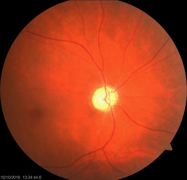 PseudoFoster Kennedy Syndrome A Rare Presentation of Diabetes Mellitus